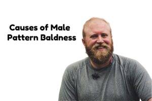 male-pattern-baldness
